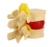 1:1.5 Étude de modèle de démonstration de hernie discale lombaire Apprendre la colonne vertébrale humaine