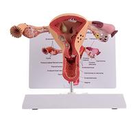 1 Modèle D'anatomie des Organes Reproducteurs Féminins, Modèle D'utérus, Modèle Anatomique D'utérus Pathologique Et D'ovaire - Anatomie Médicale Féminine Humaine.