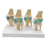 1pc Modèle D'anatomie de L'articulation du Genou Pathologique Humaine En