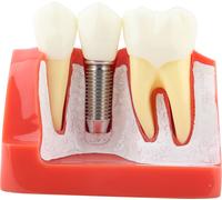 1pc Resin Dental Demonstration Tooth Model Implant Analysis Crown Bridge for Dentist (modèle de dent en résine pour démonstration dentaire)
