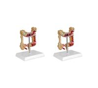 2X Modèle de Cancer Colorectal Pathologique Du Côlon Modèle de Gros Intestin Modèle Anatomique Gastro-Intestinal