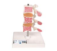 3B Scientific A78 Modèle d’Ostéoporose de Luxe, 3 Vertèbres + Application anatomie gratuite - 3B Smart Anatomy