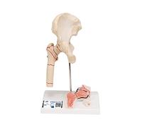 3B Scientific A88 Fracture du Fémur et Usure de l'Articulation de la Hanche + Application anatomie gratuite - 3B Smart Anatomy