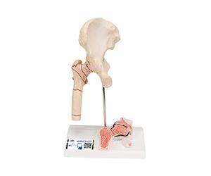 3B Scientific A88 Fracture du Fémur et Usure de l'Articulation de la Hanche + Application anatomie gratuite - 3B Smart Anatomy