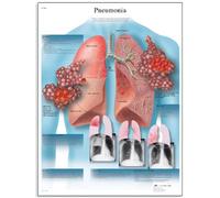 3B Scientific - Anatomie humaine - la pneumonie