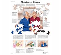 3B Scientific - Anatomie humaine - Maladie d'Alzheimer unlaminated