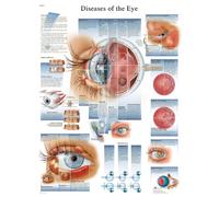 3B Scientific Anatomie humaine - Maladies de l'oeil - Version plastifiée - 1001498
