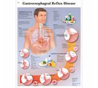 3B Scientific - Anatomie humaine - reflux gastro-oesophagien Tableau unlaminated