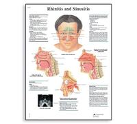 3B Scientific - Anatomie humaine - rhinite et sinusite Tableau