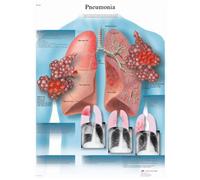 3B Scientific Anatomie humaine - Tableau de pneumonie, version plastifiée