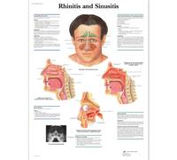 3B Scientific Anatomie humaine - Tableau de rhinite et sinusite, version plastifiée