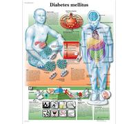 3B Scientific Anatomie humaine - Tableau Diabète sucré, version plastifiée