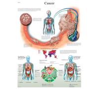 3B Scientific Église laminée - Cancer - Anglais
