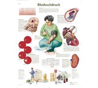 3B Scientific Graphique Hypertension, 1