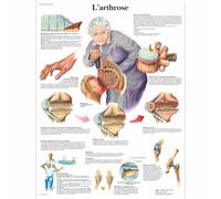 3B Scientific - Laminé Arthrose Affiche - Poster d’Anatomie & Pathologie Protégé contre UV et Poussière pour Étude, Enseignement et Cliniques