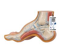 3B Scientific M32 Pied Creux, Pes Cavus + Application anatomie gratuite - 3B Smart Anatomy