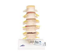3B Scientific A795 Evolution de la Hernie Discale et Dégénérescence Vertébrale + Application anatomie gratuite - 3B Smart Anatomy