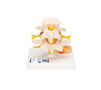 3B Scientific A76 Modèle de Vertèbres Lombaires avec Prolapsus des Disques Intervertébraux + Application anatomie gratuite - 3B Smart Anatomy