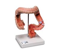 3B Scientific® Modèle Pathologique du Côlon - Gros Intestin & Rectum Taille Réelle avec Démonstration des Maladies Courantes + Smart Anatomy App (Garantie de 5 Ans)