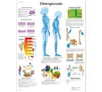 3B Scientific ostéoporose Chart, laminated, 1
