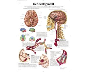 3B Scientific Planche anatomique en allemand sur l'accident vasculaire cérébral, 1