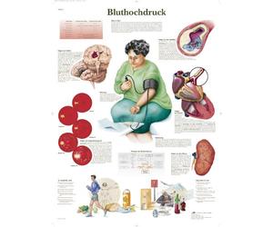 3B Scientific Planche anatomique en allemand sur l'hypertension Bluthochdruck, 1