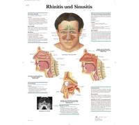 3B Scientific Planche anatomique « Rhinite et sinusite » en allemand