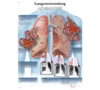 3B Scientific Tableau anatomique - Plungonite