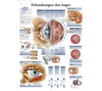 3B Scientific Tableau d'argile - maladies de l'œil VR0231UU