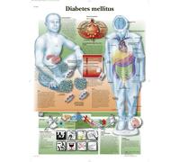 3B Scientific Tableau éducatif laminé - Diabetes melllitus
