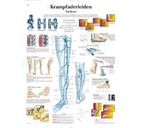 3B Scientific Tableau éducatif plastifié avec varices et varices