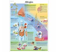 3B Scientific Tableau éducatif sur les allergies, système immunitaire, réactions allergiques et mécanismes de l'allergie