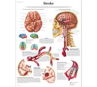 3B Scientific - Tableau Laminé de l’Accident Vasculaire Cérébral - Affiche d’Anatomie & Pathologie Protégée contre les UV et la Poussière pour Étude, Enseignement & Cliniques