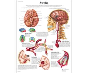 3B Scientific - Tableau Laminé de l’Accident Vasculaire Cérébral - Affiche d’Anatomie & Pathologie Protégée contre les UV et la Poussière pour Étude, Enseignement & Cliniques