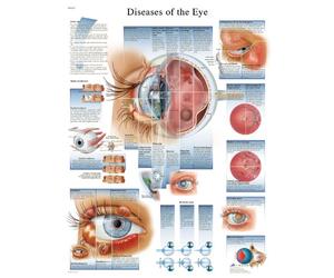 3B Scientific - Tableau Laminé des Maladies de l’Œil - Affiche d’Anatomie & Pathologie Protégée contre les UV et la Poussière pour Étude, Enseignement & Cliniques