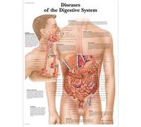 3B Scientific - Tableau Laminé des Maladies du Système Digestif - Affiche de Pathologie Protégée contre les UV et la Poussière pour Étude, Enseignement & Cliniques