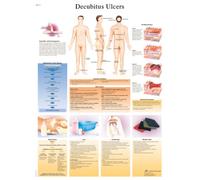 3B Scientific - Tableau Laminé des Ulcères de Décubitus - Affiche de Pathologie Protégée contre les UV et la Poussière pour Étude, Enseignement & Cliniques