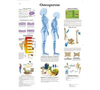3B Scientific Tableau Ostéoporose laminée, 1