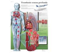 3B Scientific Vr3368l imprimés en papier, Deep Vein Thrombose