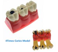 4 Fois Les Modèles De Caries,Modèle De Dents De Carie Pour Montrer La Progression Des Caries,Fistule Fuchsia,Modèle De Recherche