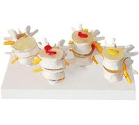 4 Partie Modèle Combiné Normal Lésions La Colonne Vertébrale Lombaire Et Les Lésions De La Vertébrale Lombaire Montrer Une Médecine Discopathie Théorie des Modèles Pathologiques