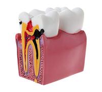 6 Caries Comparation Anatomie Dents Modèle pour Anatomie Lab Thé Crâne Anatomique avec Muscles