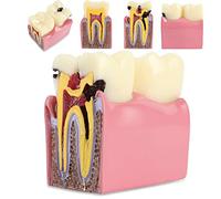 6 fois la carie des dents modèle d'étude comparative carie dentaire modèle de dent carie comparaison bilatérale pathologie modèle de dents enseignement outils d'apprentissage