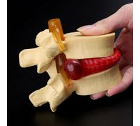 Accessoires Anatomiques De La Colonne Vertébrale Pour Enseignement Médical, Modèles D'anatomie, Outils Médicaux, Hernie Discale, Lombaires, Affranchissement Gratuit, Sans Frais De Port