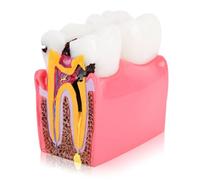 Agatige Modèle d'anatomie Dentaire, modèles d'étude de comparaison de Caries Modèle de Dents d'éducation à l'anatomie Dentaire de Dentiste Modèle de développement de Caries dentaires pour L'éducation