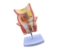 Aide à l'anatomie éducative, pathologie rectale | Modèle de pathologie en PVC à pan coupé pour démonstration en ormation à la leçon, aide à l'étude