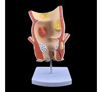 Akatsukiqi 1pc Anatomique de Rectum Humain pathologie lésion modèle hémorroïdes Anus médical matériel d'enseignement