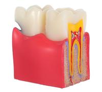 Alipis Modèle Pédagogique Pour Dents Cariées Outil Enseignement Comparatif De Caries Dentaires Modèle De Dent Pour Étudiants Et Patients
