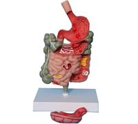 AMITD Grand modèle de pathologie intestine, anatomie humaine, amovible pour l'enseignement