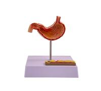 AMITD Modèle de stomach pathologique de taille réelle, numéroté et détachable avec base